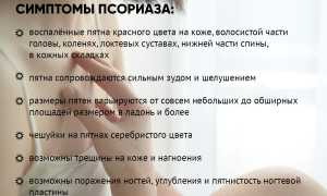 Действительно ли псориаз передается по наследству? Важные факты и исследования