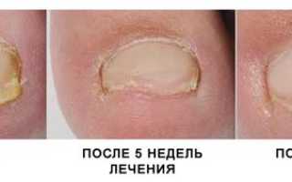 Как при помощи лазера лечить грибок ногтей? Полезные советы и рекомендации