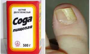 Самое простое средство от грибка ногтей на ногах — сода для здоровья