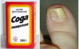 Самое простое средство от грибка ногтей на ногах — сода для здоровья