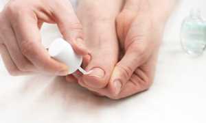 Как выбрать лечебный лак от грибка ногтей для эффективного лечения