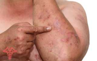 Побочный эффект употребления алкоголя при псориазе: важные аспекты