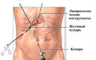 Лапароскопия печени