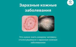 Пути заражения и меры предосторожности от стригущего лишая: важные рекомендации для здоровья