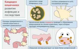 Кишечный кандидоз — диагностика и лечение заболевания у взрослых