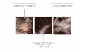 В чем разница между заболеваниями псориаз и себорейный дерматит: основные аспекты