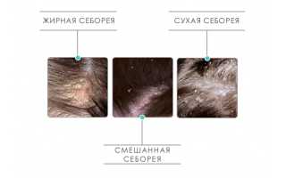 В чем разница между заболеваниями псориаз и себорейный дерматит: основные аспекты