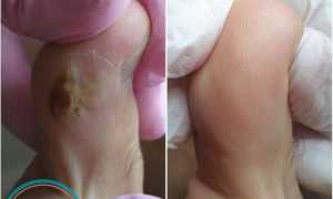 Полезные советы о том, как не допустить опрелости между пальцами ног для здоровья