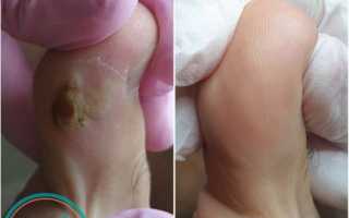 Полезные советы о том, как не допустить опрелости между пальцами ног для здоровья