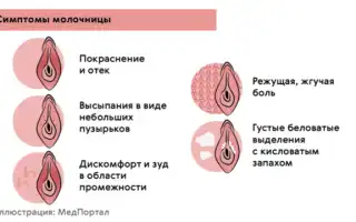 Виды и причины неприятных выделений при молочнице: что нужно знать