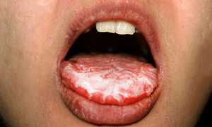 Чем опасна запущенная форма кандидоза для организма человека