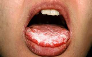 Чем опасна запущенная форма кандидоза для организма человека