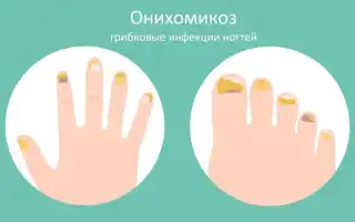 Действенные методы лечения грибка уксусом в домашних условиях: советы и рекомендации