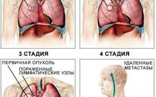 Диета при метастазах в печени