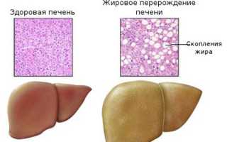 Жировые отложения в печени