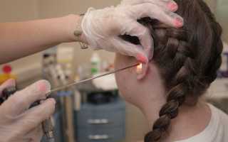 Диагностика грибка в ушах и способы лечения заболеваний уха