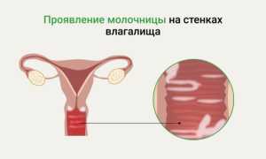 Причины появления грибка в паху у мужчин: важные аспекты здоровья