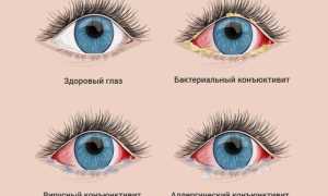 Опасное инфекционное заболевание кандидоз глаз: симптомы и лечение
