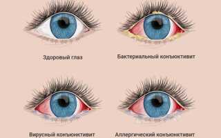 Опасное инфекционное заболевание кандидоз глаз: симптомы и лечение