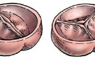 Фиброз что это