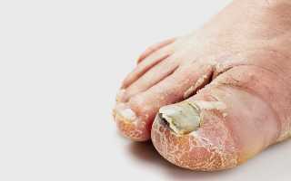 Что такое дерматомикоз стоп и как его лечить? Полное руководство