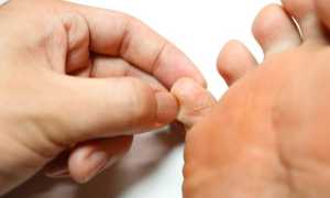 Как лечить грибок на руках между пальцами мазью и таблетками: советы и рекомендации