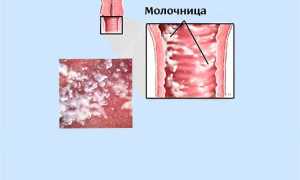 Кандидоз после приема антибиотиков: причины и лечение