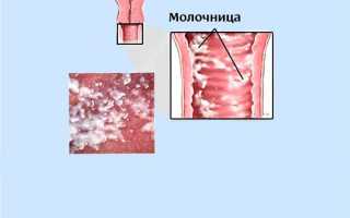 Кандидоз после приема антибиотиков: причины и лечение