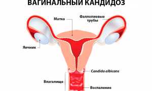 Эффективные методы лечения и профилактики анального кандидоза у пациентов