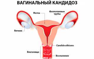 Эффективные методы лечения и профилактики анального кандидоза у пациентов