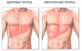 Увеличение левой доли печени