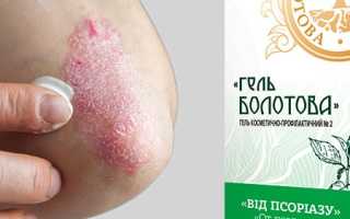 Лечение с помощью уксуса поражения кожных покровов — псориаза и его особенностей