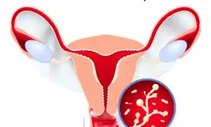 Лечение молочницы дома в период беременности: советы и рекомендации