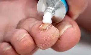 Почему мази являются эффективным средством от грибка на руках и ногах