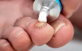 Почему мази являются эффективным средством от грибка на руках и ногах