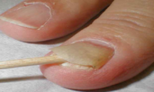 Чем вызвано появление грибка ногтей на руках и как избавиться от него эффективно