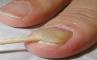 Чем вызвано появление грибка ногтей на руках и как избавиться от него эффективно