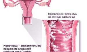 Особенности лечения молочницы у девственниц: важные аспекты и рекомендации