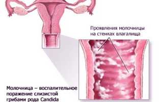 Особенности лечения молочницы у девственниц: важные аспекты и рекомендации