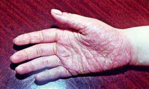 Что такое ладонно-подошвенный псориаз? Советы по лечению заболевания и его профилактике