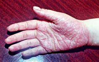 Что такое ладонно-подошвенный псориаз? Советы по лечению заболевания и его профилактике