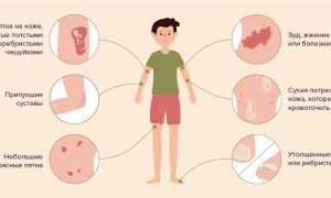 Чешется кожа при псориазе или нет? Узнайте причины и решения