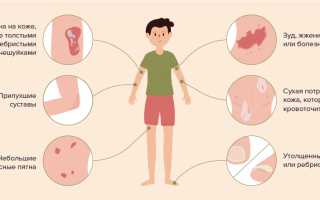 Чешется кожа при псориазе или нет? Узнайте причины и решения