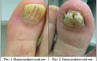 Что такое гипертрофический онихомикоз и как его лечить: полезные советы