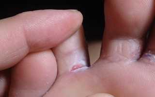 Как эффективно и максимально быстро избавиться от зуда между пальцами ног в домашних условиях