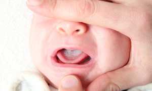 Признаки молочницы на языке у грудничка: что нужно знать