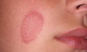 Из-за чего развивается микоз гладкой кожи и как его лечить: советы и рекомендации