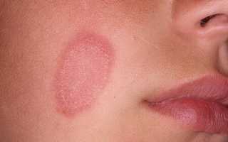 Из-за чего развивается микоз гладкой кожи и как его лечить: советы и рекомендации