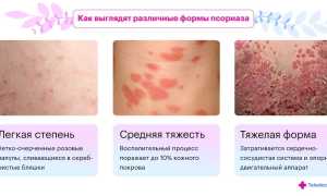 Причины, стадии развития псориаза на ногах и его лечение: полезные советы и рекомендации