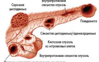 Диффузия поджелудочной железы